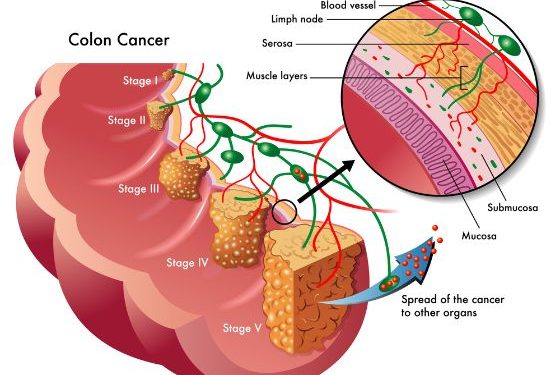 Colon Cancer Survival Rate by Age