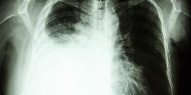 Lung Cancer at Stage 4