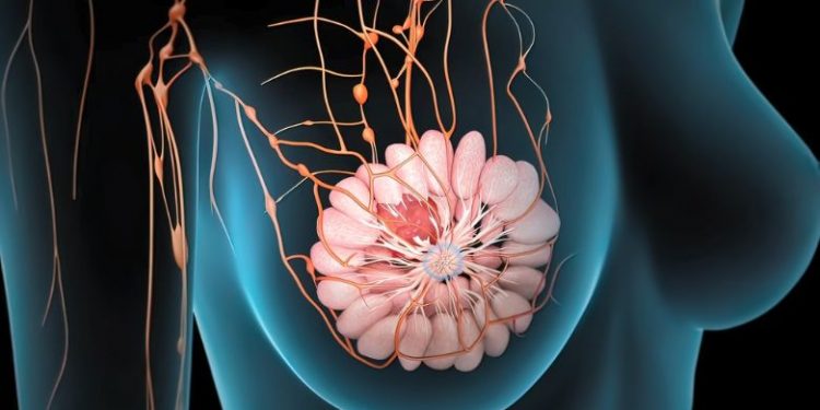 What Happens When You Have a Breast Cancer Lump?