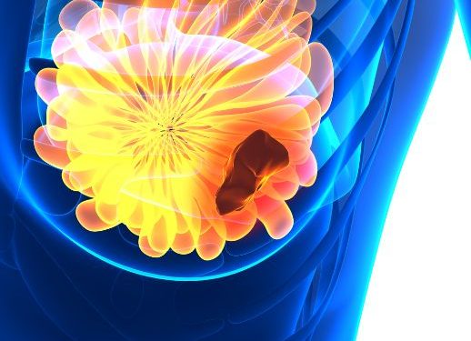 Types of Breast Cancer