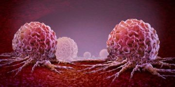 Brain Metastases – Signs, Symptoms and Treatment