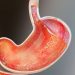 Gastroesophageal Junction Cancer
