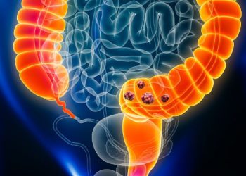 Stage 4 Adenocarcinoma