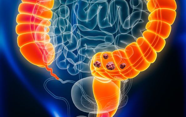 Stage 4 Adenocarcinoma