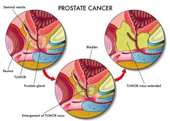 Urinary and Sexual Function 1 Year After Radical Prostatectomy