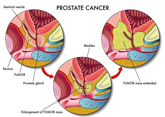 Urinary and Sexual Function 1 Year After Radical Prostatectomy