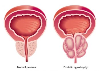 Stage 4 Prostate Cancer