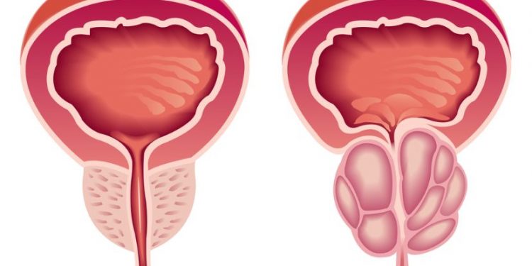 Stage 4 Prostate Cancer