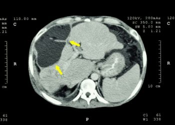 Stage 4 Liver Cancer Symptoms and Treatments