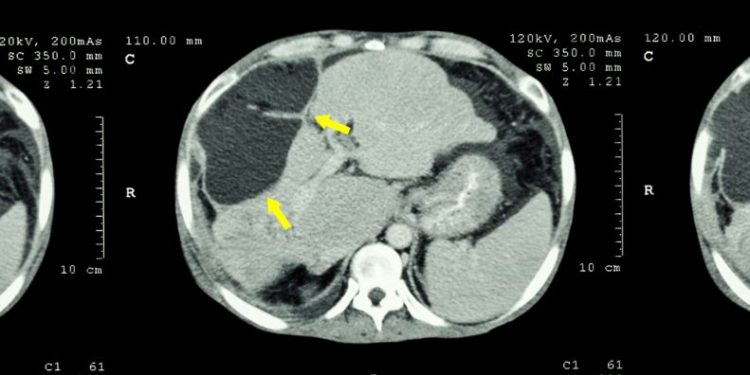 Stage 4 Liver Cancer Symptoms and Treatments