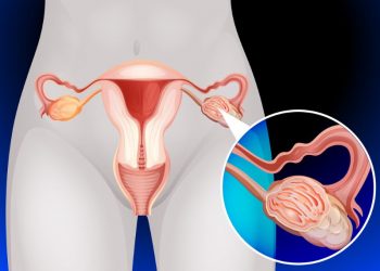 Stage 4 Ovarian Cancer