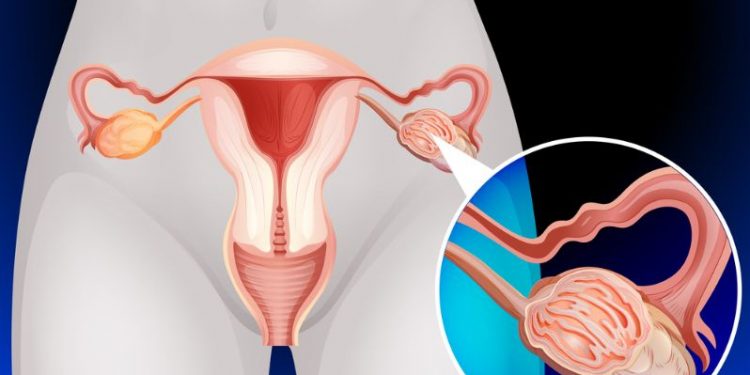 Stage 4 Ovarian Cancer