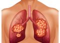What is My Outlook For Stage 4 Kidney Cancer Spread to Lungs Life Expectancy?
