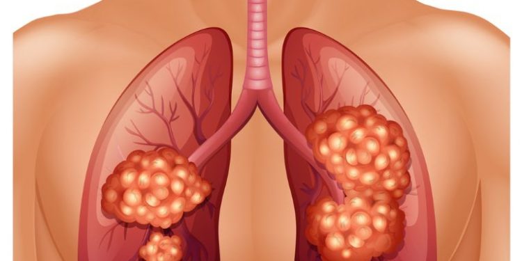 What is My Outlook For Stage 4 Kidney Cancer Spread to Lungs Life Expectancy?