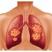 What is My Outlook For Stage 4 Kidney Cancer Spread to Lungs Life Expectancy?