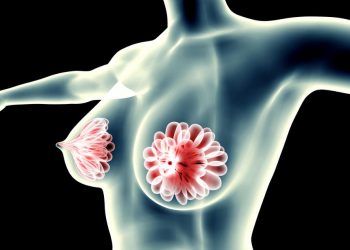 Breast Cyst Symptoms Oren Zarif