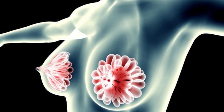 Breast Cyst Symptoms Oren Zarif