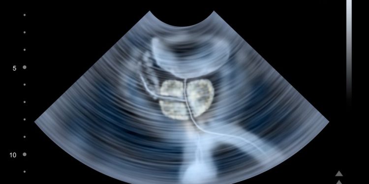 Protecting Your Prostate Health