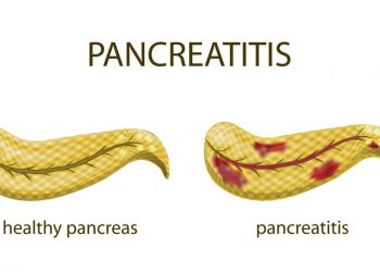 Pancreatitis