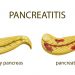 Pancreatitis