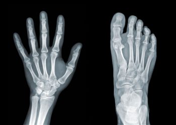 Osteosarcoma in Children