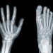 Osteosarcoma in Children