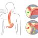 Esophageal Squamous Cancer