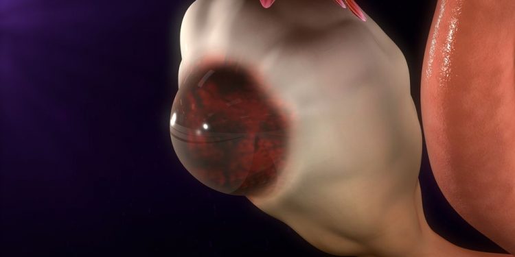 Thick Endometrial Lining