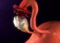 Intramural Uterine Fibroid