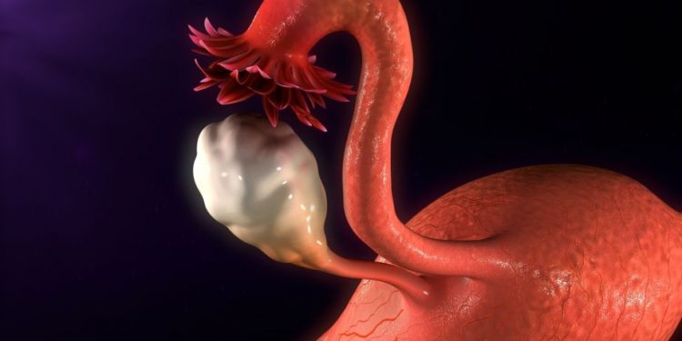Intramural Uterine Fibroid