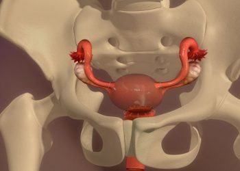 Endometrial Stromal Sarcoma