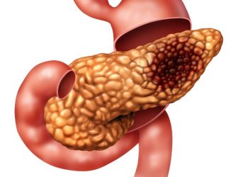 How to treat pancreatic cancer