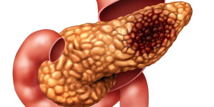 How to treat pancreatic cancer