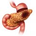 How to treat pancreatic cancer