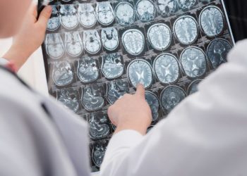 Hemorrhagic Stroke Symptoms and Treatment