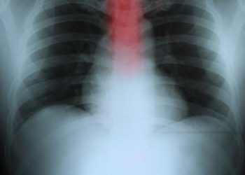 Esophageal Adenocarcinoma