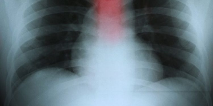 Esophageal Adenocarcinoma