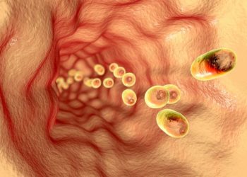 What You Need to Know About Esophageal Dysphagia