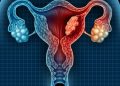 Endometrial Cancer Staging
