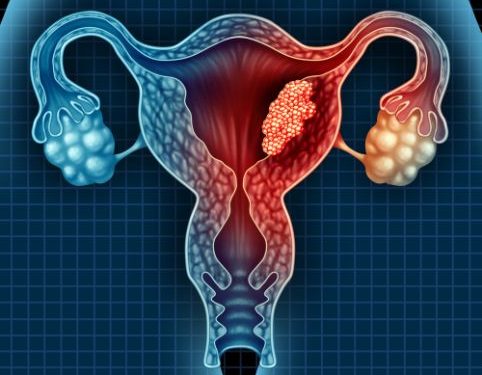 Endometrial Cancer Staging