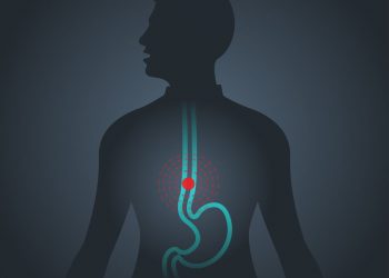 Esophageal Cancer