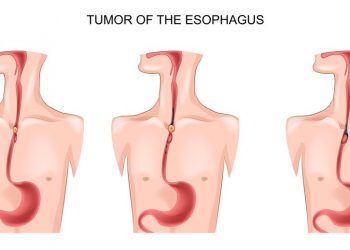 Unusual Symptoms of Esophageal Cancer