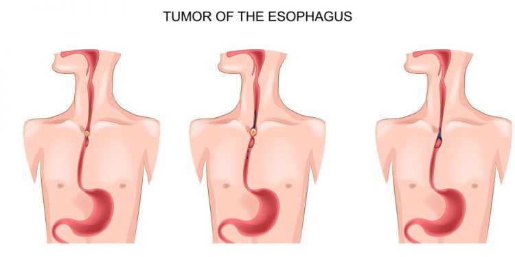 Unusual Symptoms of Esophageal Cancer