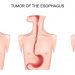 Unusual Symptoms of Esophageal Cancer