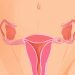 Womb Cancer Symptoms and Treatment