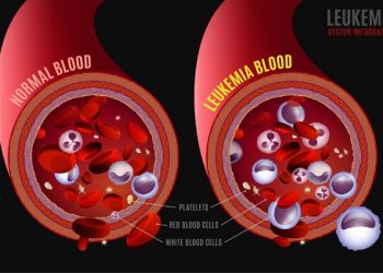 Acute Myeloid Leukemia