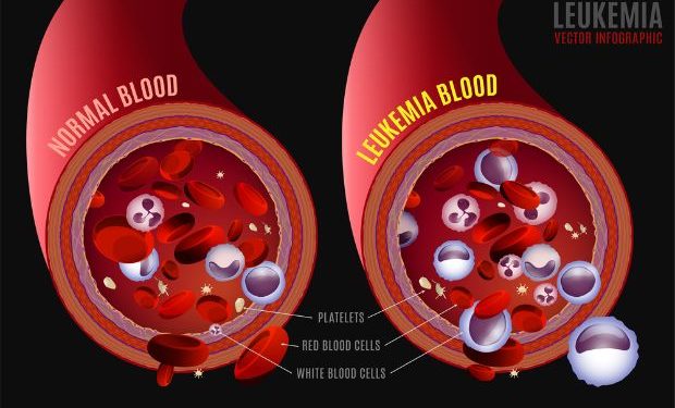 Acute Myeloid Leukemia