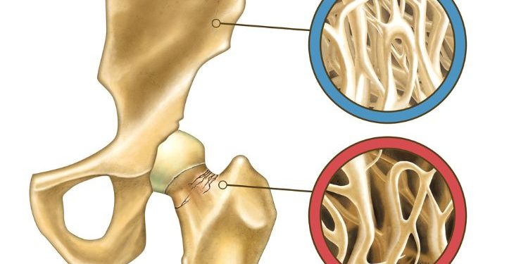 Bone Metastasis