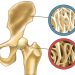 Bone Metastasis