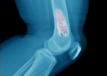What is a Bone Tumor?